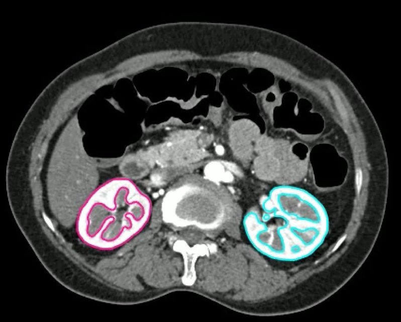 Kidney cortex AI auto-segmentation CT